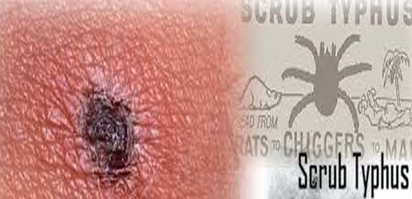 1 person dies of scrub typhus in IGMC